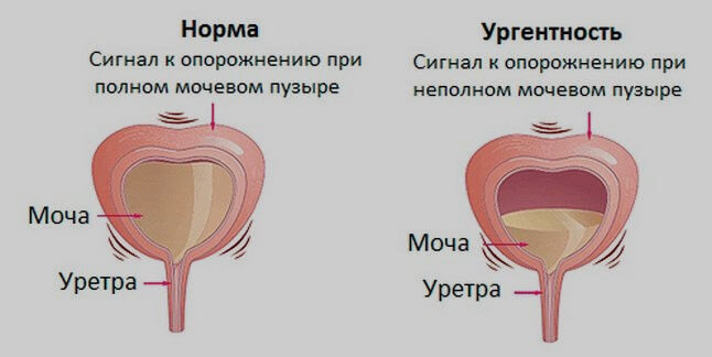 состояния мочевого пузыря